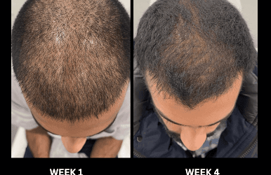 PRP for Hair Loss: Understanding the Revolutionary Treatment and Its Safety