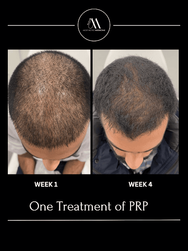 PRP For Hair Loss